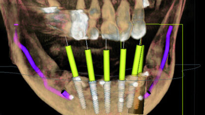 Advantages of 3-D planning for implants