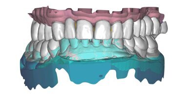 Procedure digitali per il design di una occlusione sequenziale in un caso clinico complesso