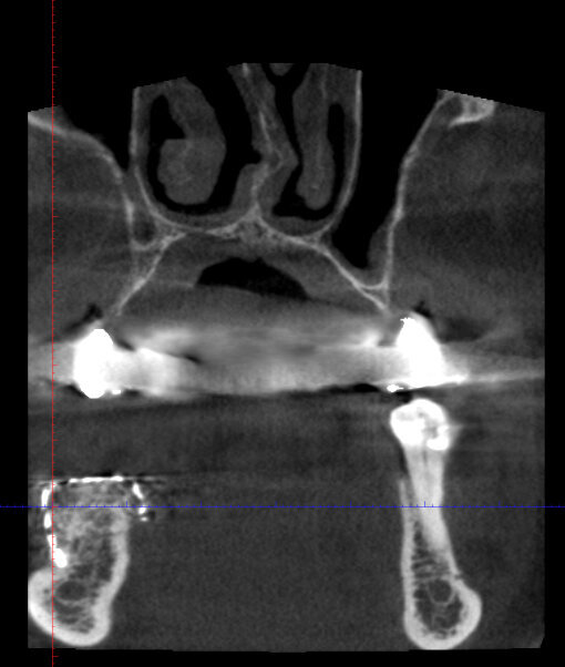 Figg. 6a, 6b_Sezioni di CBCT dopo l’intervento che mostrano l’incremento osseo ottenuto.