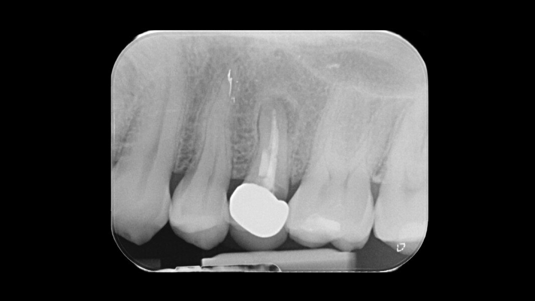 Fig. 1_RX iniziale (T0).
