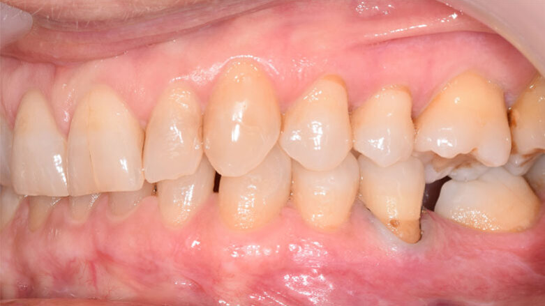 Progettazione ortodontica digitale di un caso di scissor bite