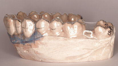 Protocolo del CA® Clear-Aligner en varios pasos a partir de mismo modelo