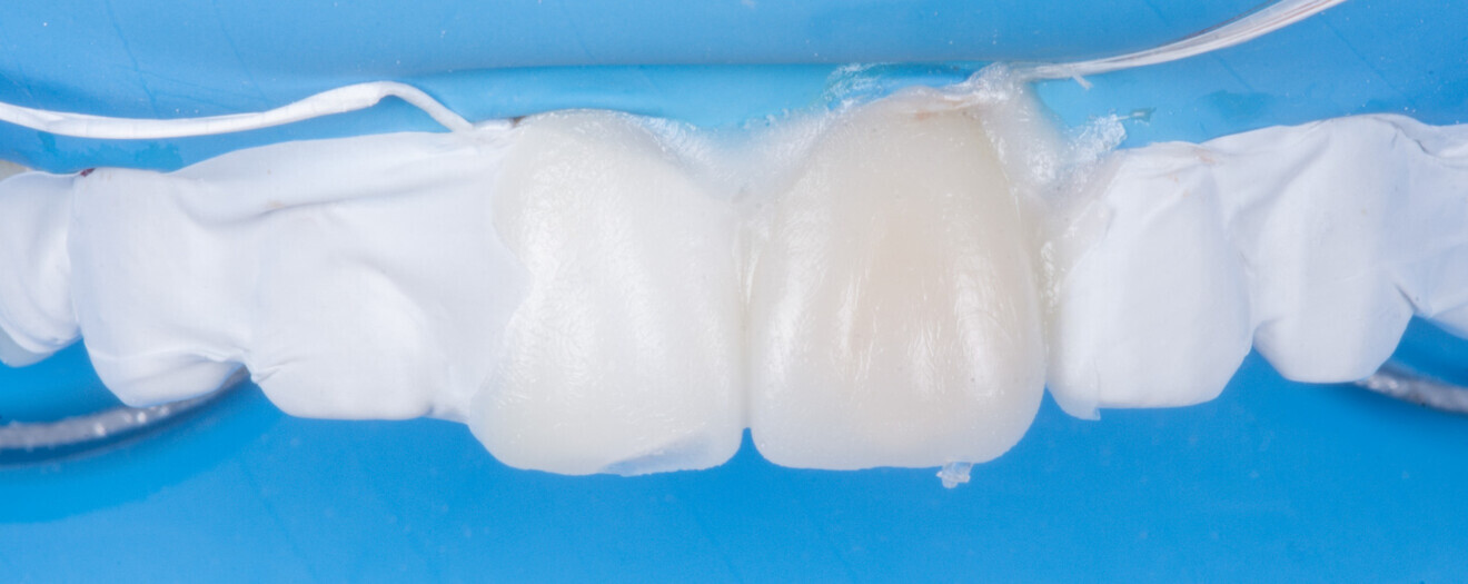 Fig. 13 : Résultat brut après injection.