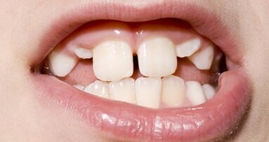 Wady zgryzu trzeba leczyć!