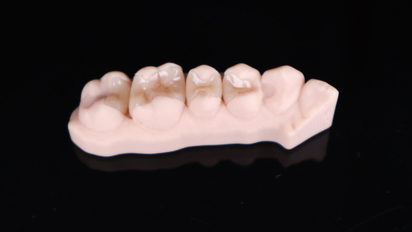 Fig. 5: 3D-printed restorations fitted on a printed dental model.