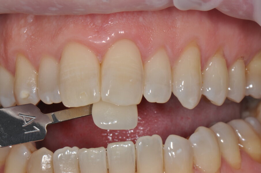 Fig. 10 - Colore finale utilizzando la scala “Vita” A1.