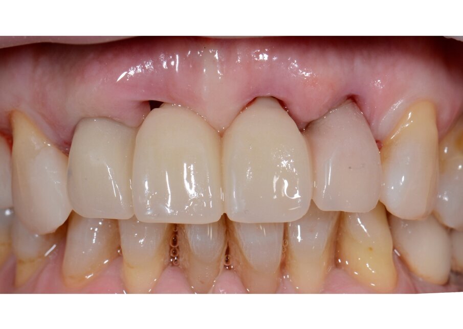 Fig. 64 - Alloggiamento del provvisorio.