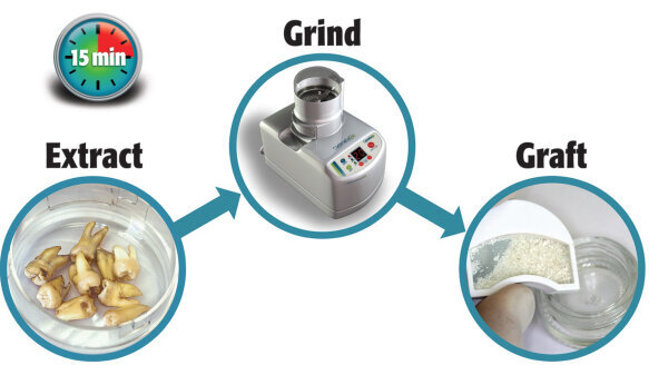 Dentists who are converting extracted teeth into bone graft report outstanding long-term results