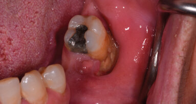 Prevenzione e management odontoiatrico dei pazienti oncologici a rischio di osteonecrosi delle ossa mascellari da farmaci