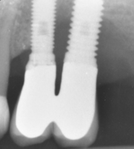 Fig.13: Case 2. Baseline. The radiography shows severe peri-implant CBL.