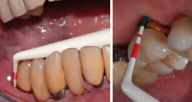 Mantenimento implantare:sondare o no?