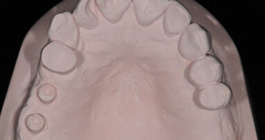 La rivoluzione delle impronte su impianti Encode® restorative system