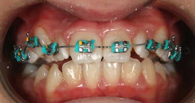 Jak zjednodušit léčebný protokol použitím drátu čtyřhranného průřezu v první fázi léčby