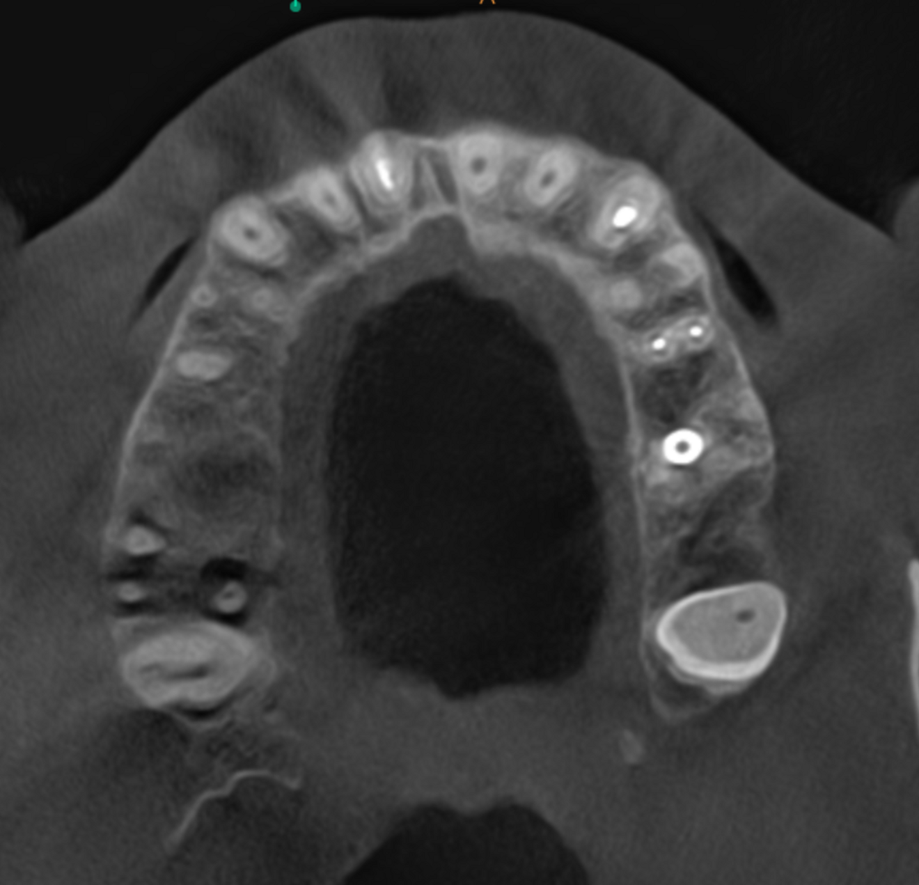 Fig. 5a: Large-volume CBCT scan. Transversal cross-section of the maxilla showing bone loss around the roots of tooth #17 and cortical wall damage.