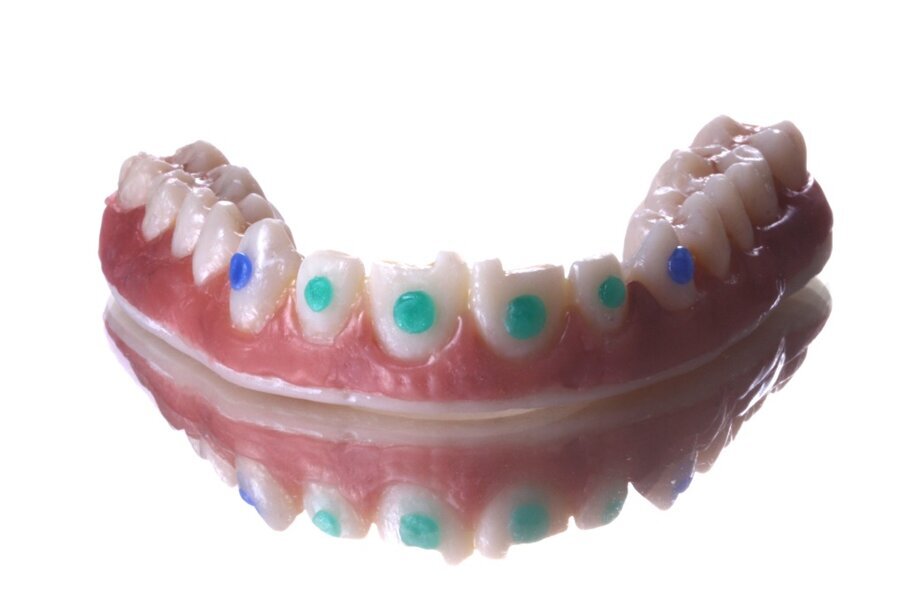 Fig. 14. Dientes después de la caracterización con incrustaciones de piedras preciosas al estilo maya.