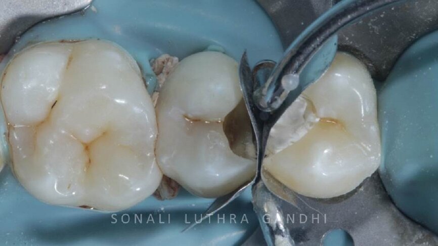 Figure 7 Sectional band and ring adaptation
