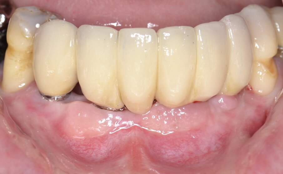 Fig. 15 - Protesi definitiva in metallo-ceramica.