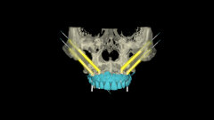 Combining robotic and dynamic implant surgery and photogrammetry for full-arch rehabilitation: A quad zygoma and mandibular implant case report