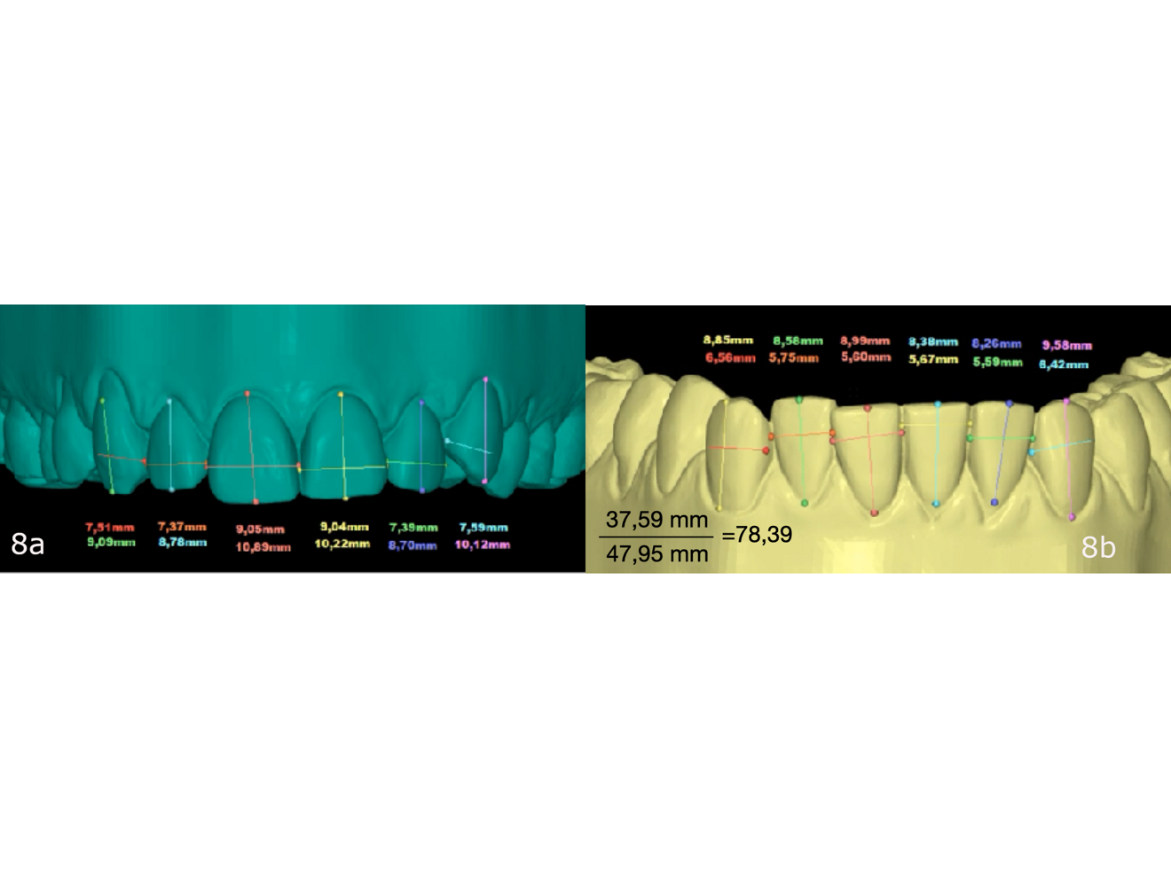 Figs. 8a & b: Measurement of the (a) maxillary and (b) mandibular anterior teeth and calculation of a Bolton discrepancy.