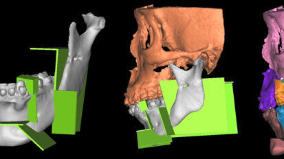 האם פרוטוקולי טומוגרפיה ממוחשבת משפיעים על הערכת המפרק הטמפורומנדיבולרי