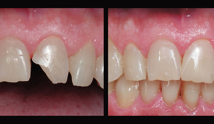 Imágenes de la restauración realizada por el Dr. Joubert antes y después del procedimiento.
