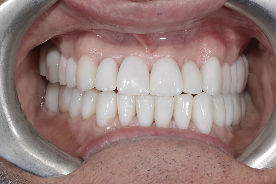 Fig. 27g: Disclusion on the left. 
