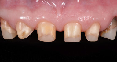 Erupción forzada en ortodoncia