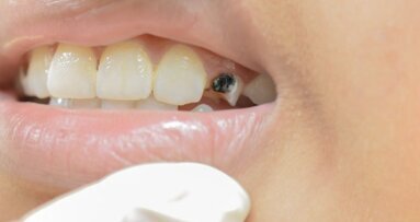 Zaawansowana próchnica i leczenie odtwórcze – aktualne rekomendacje