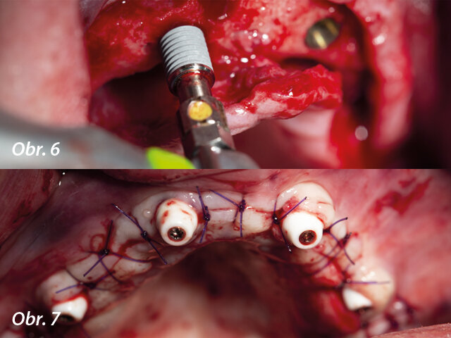 Chirurgická procedura zavádění implantátů / Konečný výsledek po chirurgické fázi
