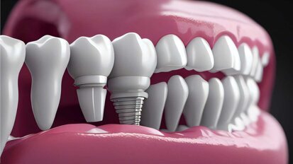 „Ceramic Implants meets Aesthetics“ im Mai in München „Ceramic Implants meets Aesthetics“ im Mai in München