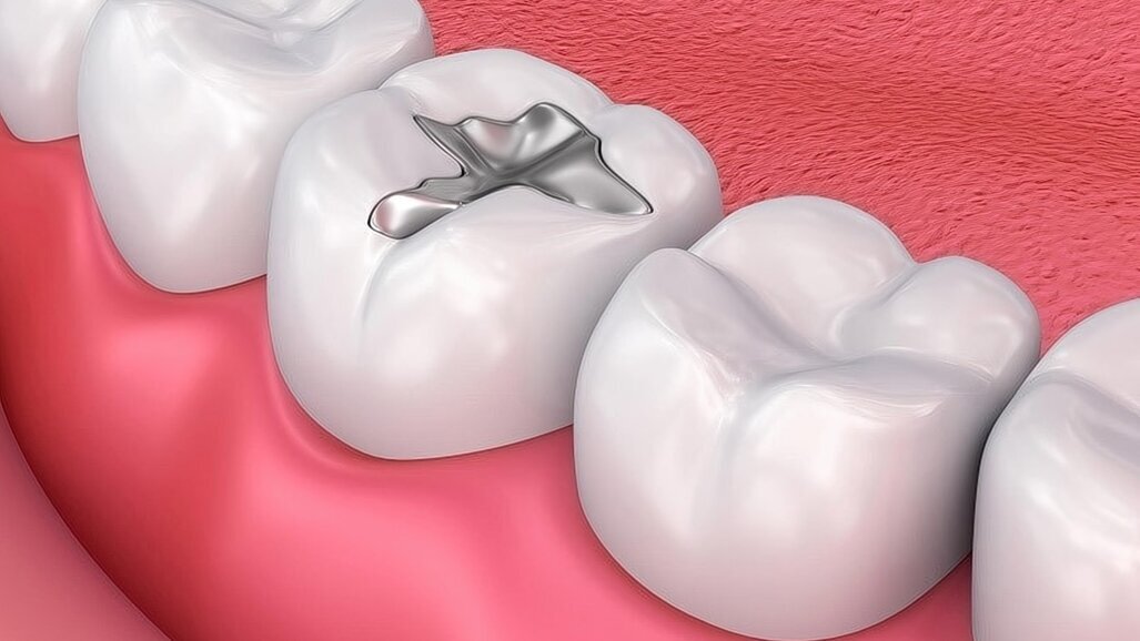 Preocupación por la eliminación prematura de la amalgama dental