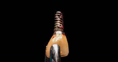 Réduire le risque de rejet des implants dentaires grâce aux biomatériaux