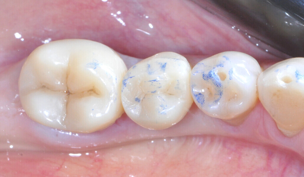 Fig. 26: Checking of the occlusal contacts. 