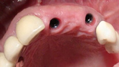 Prothèse partielle fixe implanto-vissée