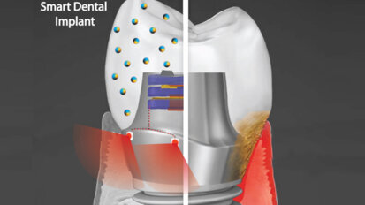Researchers developing  antibacterial smart dental implant that uses phototherapy Researchers developing  antibacterial smart dental implant that uses phototherapy