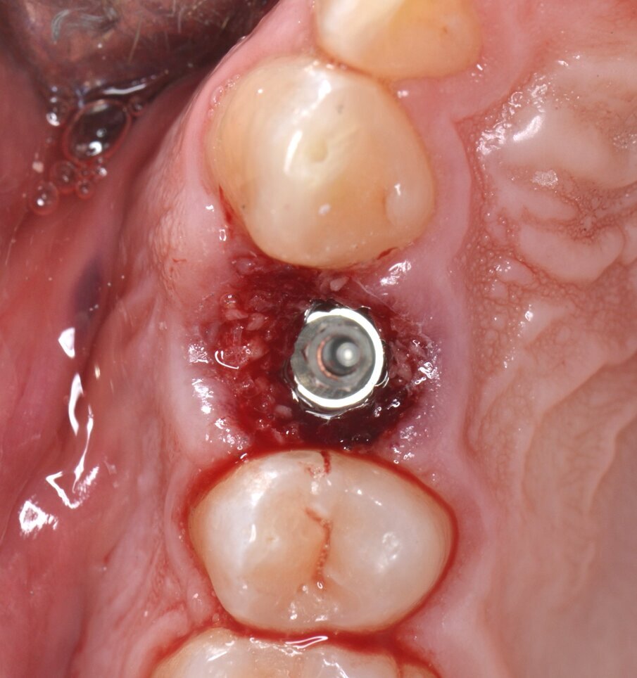 Fig. 14 - L’innesto viene eseguito in leggero overbuilding in senso verticale allo scopo di sostenere il margine gengivale.