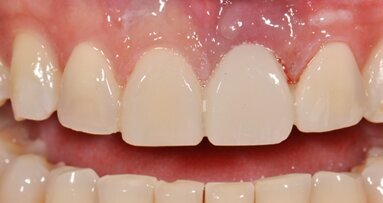 Bridge provisoire direct collé à la résine et élément de bridge composite avec bande de fibres de verre imprégnée de résine