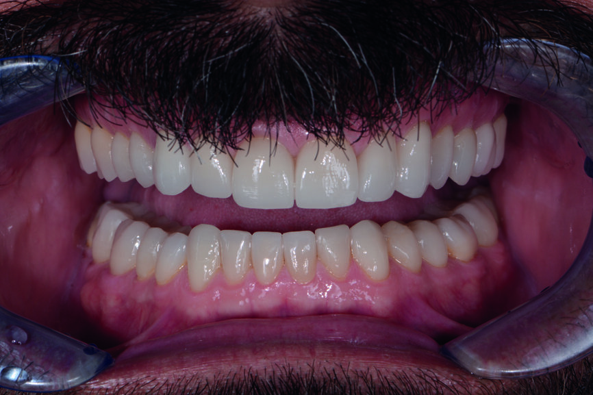 Figs. 16 et 17 : Photos de suivi en janvier 2021 montrant un résultat très stable sans aucun écaillage de la céramique et des avantages mécaniques constants mentionnés par le patient, tels que plus de céphalées de tension