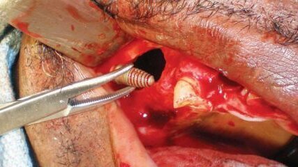 Implants migrés dans le sinus maxillaire