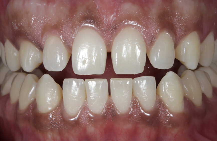 Fig. 80: Pre-op and post-op situations.