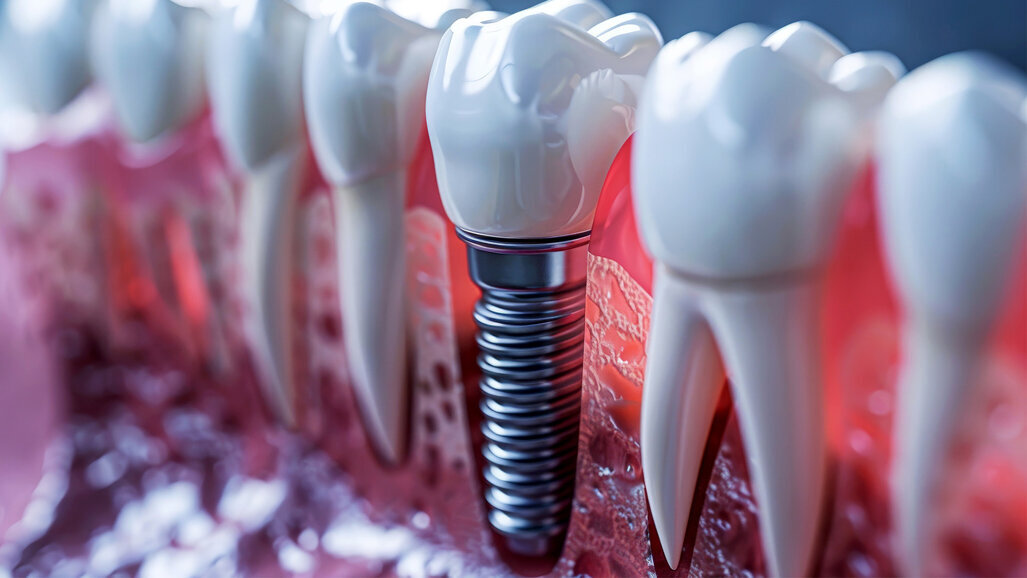 Regenerative Zahnmedizin: Biomaterialien bei der Sofortimplantation