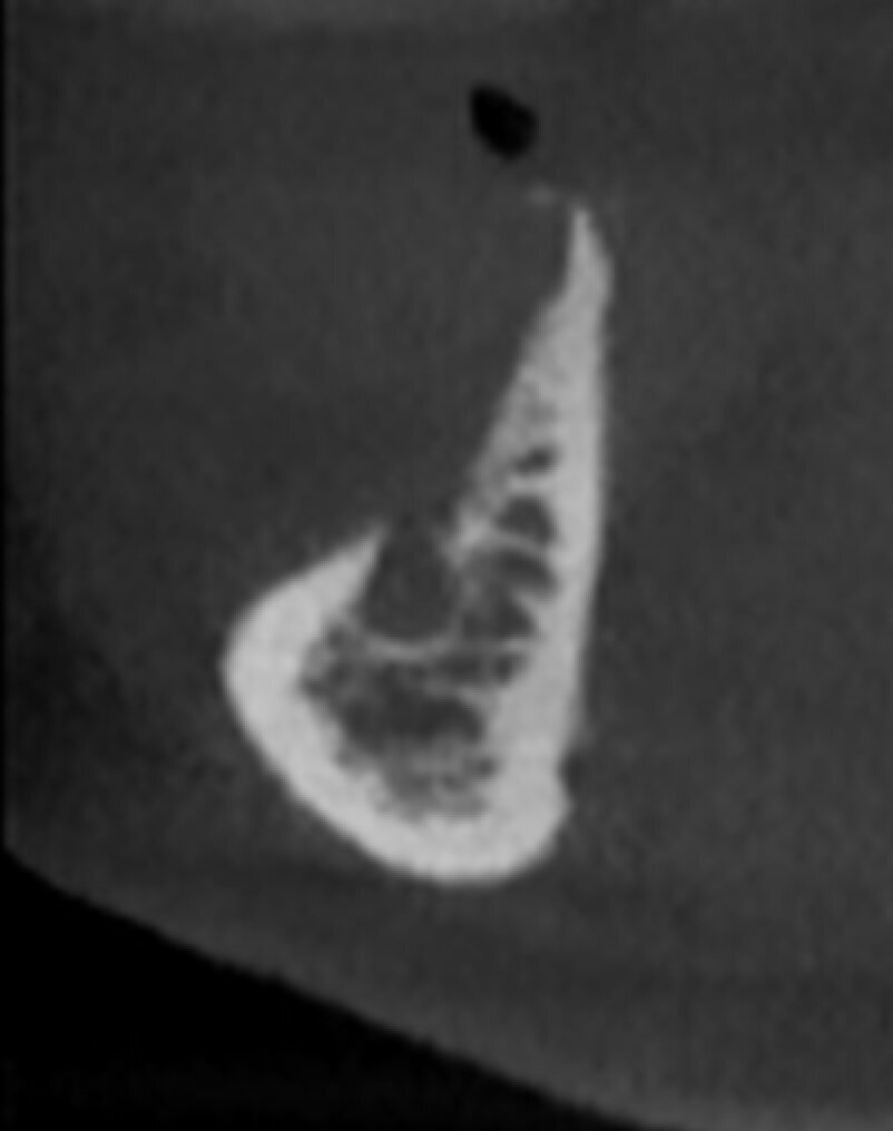 Figg. 1a-1c_Foto clinica e sezioni di CBCT iniziali in cui si evidenzia l’edentulia distale a elemento 4.3 con atrofia orizzontale estremamente accentuata e lieve atrofia verticale.
