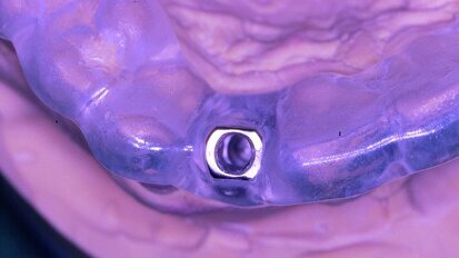Les années les plus marquantes de l’implantologie - Une rétrospective très personnelle