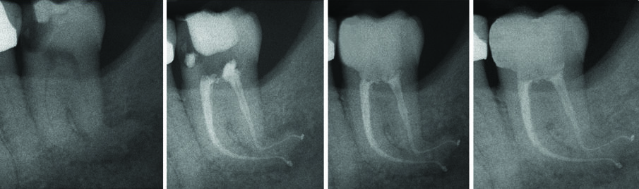 Fig. 11 - Terapia canalare 3.8.