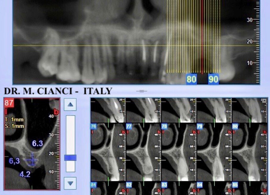 Fig. 2 - Sezione tomografica pre-chirurgica.