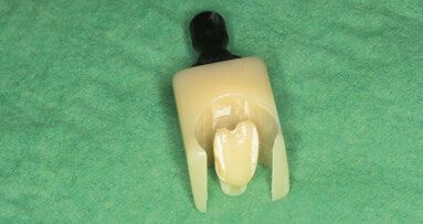 Imediátní zavedení a zatížení implantátu – digitální ordinační pracovní postup