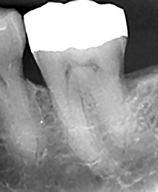 Figs. 12a–d : Depuis la gauche : Cas de l’auteur : dent
37 présentant une fracture radiculaire ; cette dent
montée dans un modèle en plâtre-pierre après extraction,
avec impression du guide de forage CTGEA
monté et du premier foret en place ; les deux
petits orifices d’accès préparés au moyen du guide
de forage ; et la radiographie postopératoire montrant
l’adaptation des cônes dans les canaux après leur négociation et leur mise en forme.
