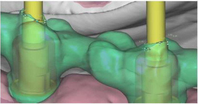 Fig. 6c: Occlusal view showing CAD of the provisional FDP framework (a) and close-up views from the interface between the CAD framework and the prefabricated titanium abutments (b & c).