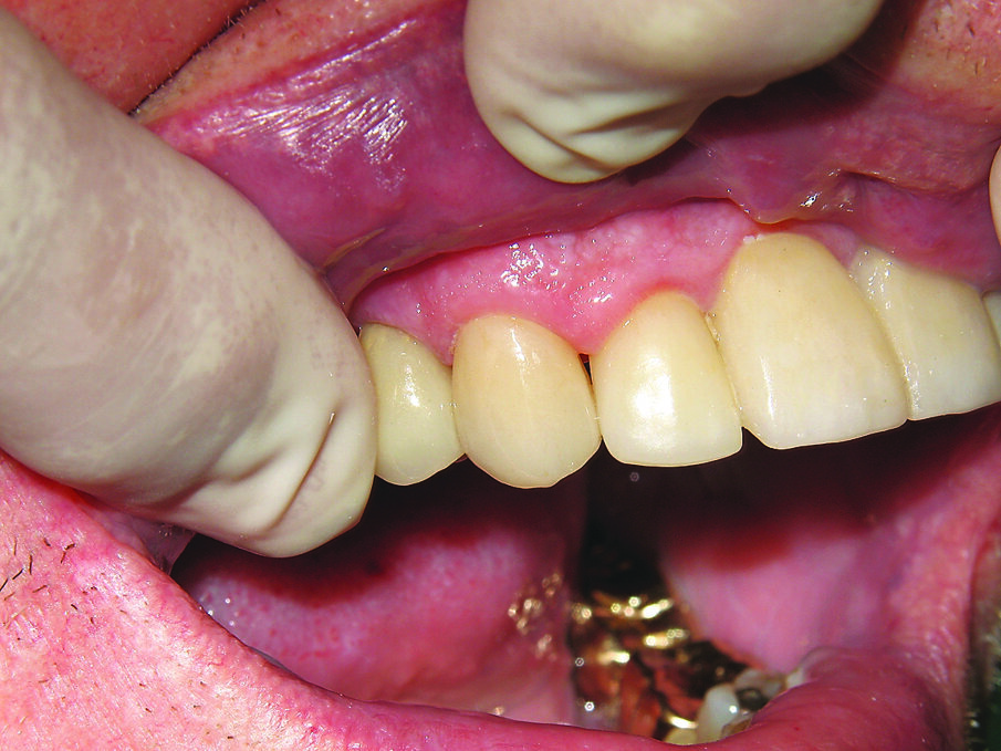 Fig. 12. Final restoration.