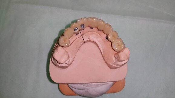 Alternatywna metoda wzajemnej stabilizacji transferów przy wykonywaniu wycisków